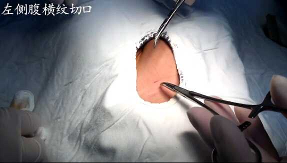 杨朔：小儿腹股沟疝（左侧）修补术