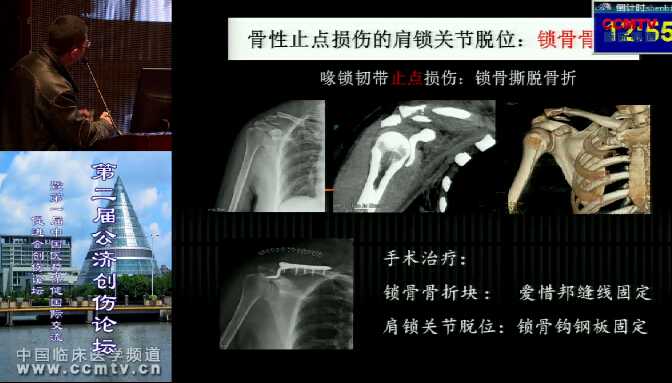 吴晓明：骨性止点损伤的肩锁关节脱位的临床表现及治疗