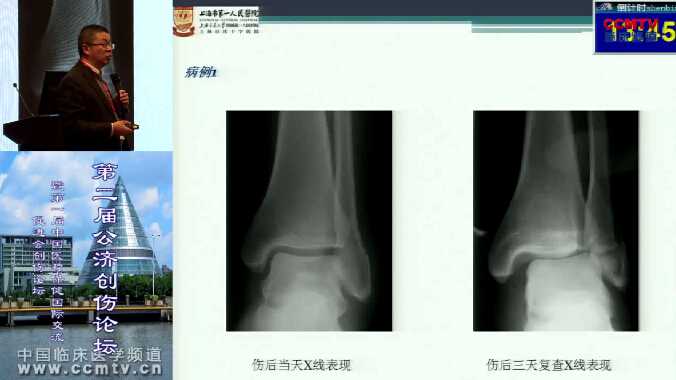黄建华：踝关节三角韧带损伤的诊断与治疗