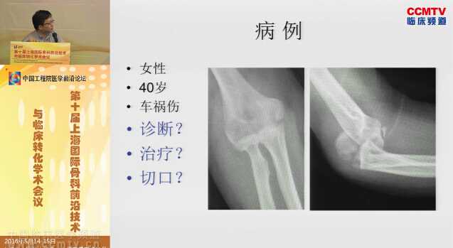 唐坚：肘前内侧入路解剖学研究与临床应用