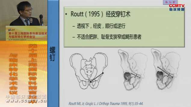 孙玉强：骨盆骨折的微创治疗与Zeego导航