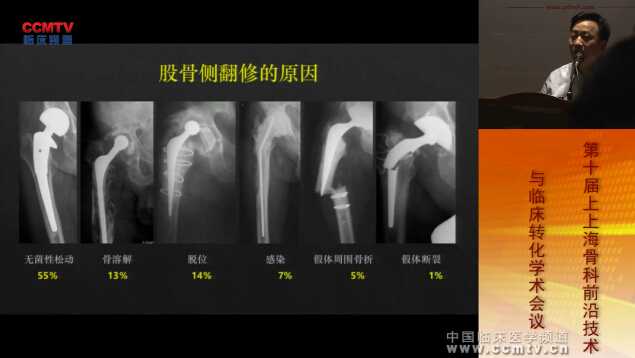 徐卫东：全髋关节置换术后股骨侧翻修-假体选择与手术技术