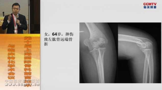 禹宝庆：肱骨远端骨折的内固定治疗