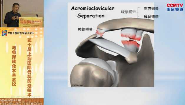 陈云丰：肩锁关节脱位影像学诊断的差异及病例分享