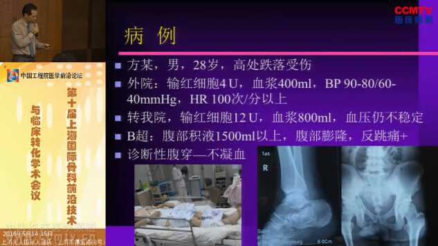 陈爱民：骨盆骨折病例分享、治疗决策与技术