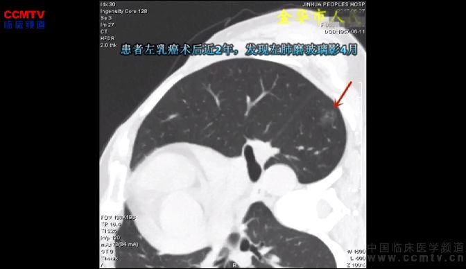 叶建明：乳腺癌术后2年发现GGO，单孔胸腔镜下左肺下叶背段切除术