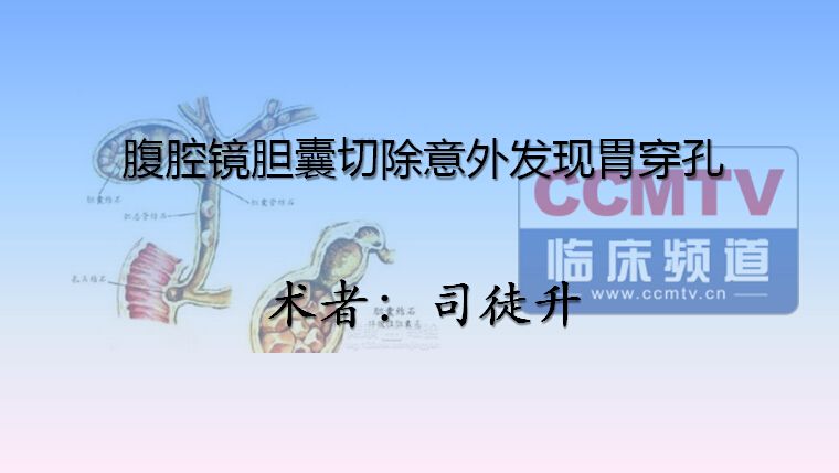 司徒升：腹腔镜下胆囊切除术中意外发现胃穿孔