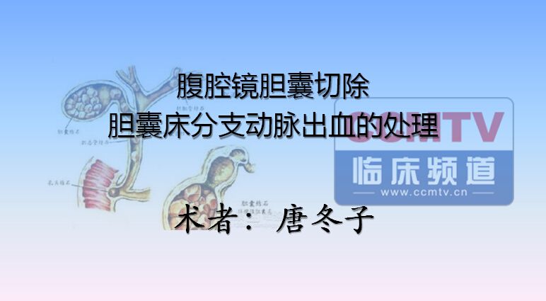 唐冬子：腹腔镜胆囊切除，胆囊床分支动脉出血的处理