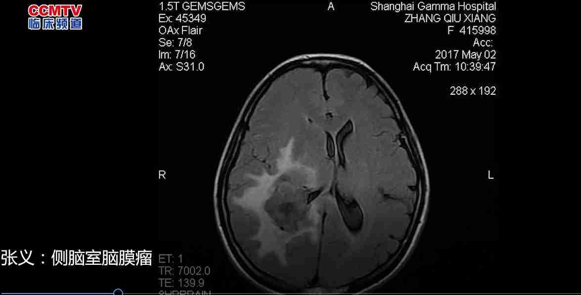 张义：侧脑室脑膜瘤