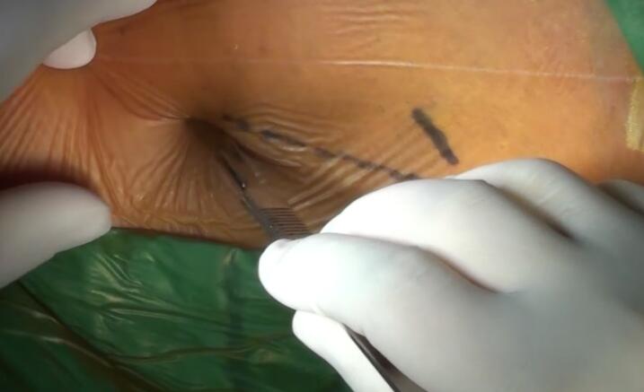 曲乐丰：改良外翻式颈动脉内膜斑块切除术