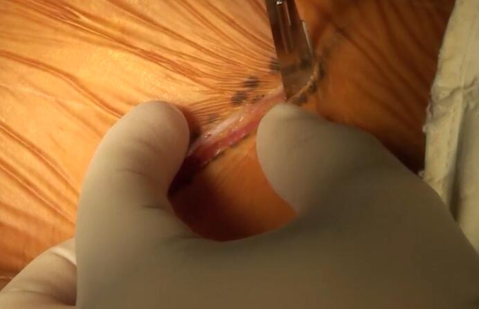 曲乐丰：现行外翻式颈动脉内膜斑块切除术