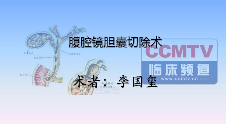 李国玺：腹腔镜胆囊切除术