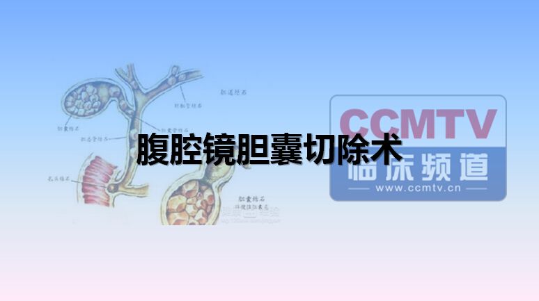 腹腔镜胆囊切除术