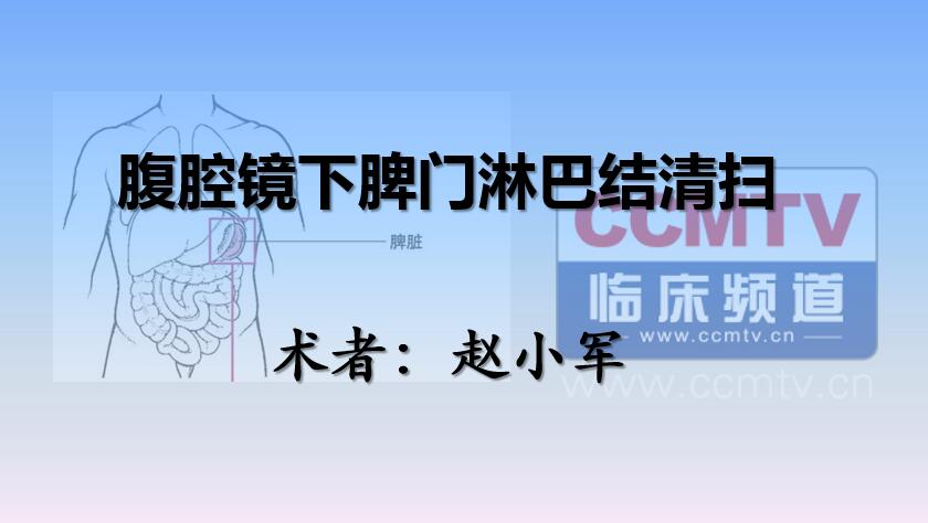 赵小军：腹腔镜下脾门淋巴结清扫