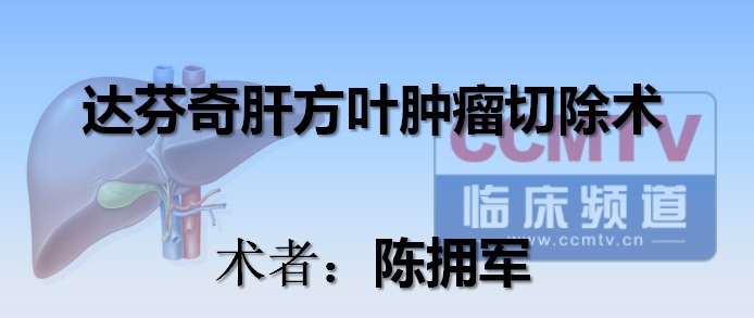 陈拥军：达芬奇肝方叶肿瘤切除术