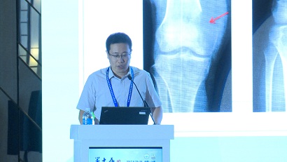 杨庆诚：地诺单抗在骨巨细胞瘤外科治疗中的价值