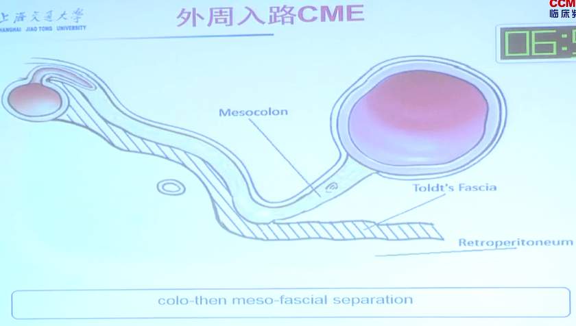 冯波：腹腔镜右半结肠CME的指纹——横结肠后间隙与Henle干