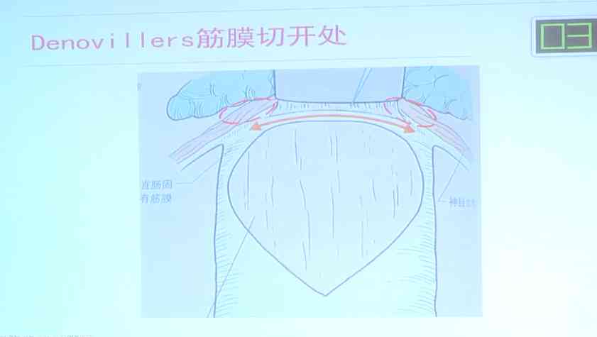 叶凯：腹腔镜直肠癌前侧方间隙分离与盆丛、血管神经束的认识