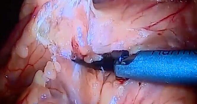 冯士春：中央入路腹腔镜右半结肠切除术