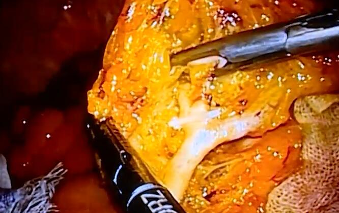 周易明：腹腔镜左半结肠切除腔内吻合术