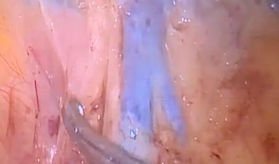 孙晶：腹腔镜下右半结肠癌D3根治术