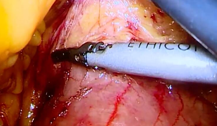 曹跃鹏：腹腔镜下右半结肠尾侧及中间入路根治术