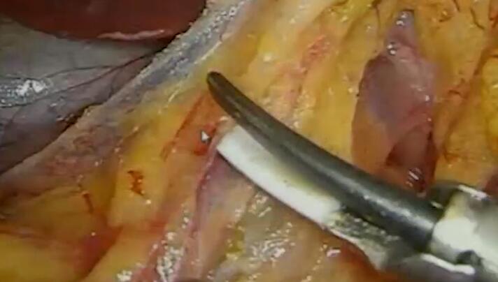 联合中间入路腹腔镜辅助根治性右半肠切除术