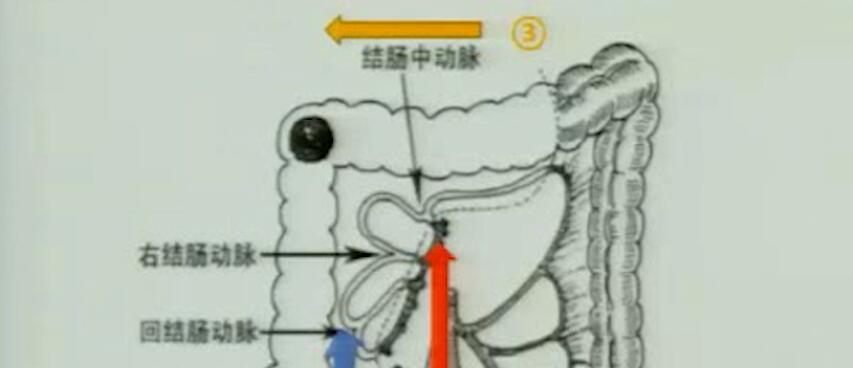 腹腔镜尾侧入路右半结肠癌D3根治术