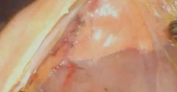 腹腔镜左半结直肠根治术