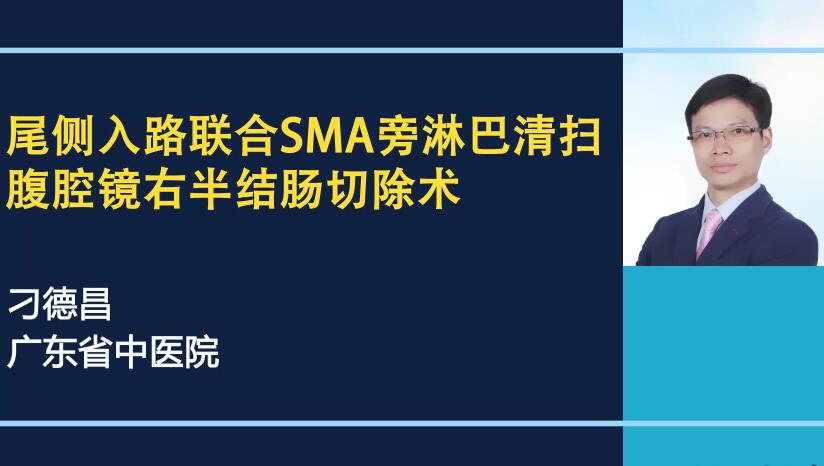 刁德昌：尾侧入路联合SMA旁淋巴清扫腹腔镜右半结肠切除术