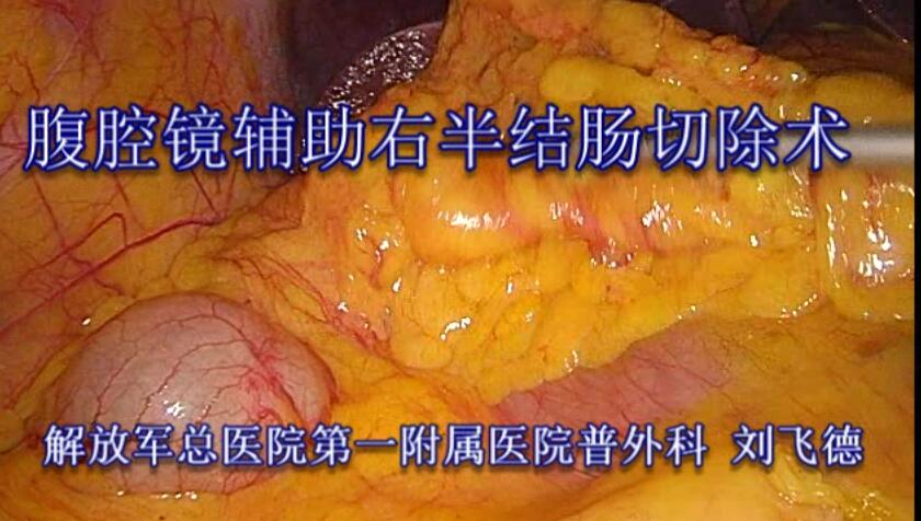 刘飞德：腹腔镜辅助右半结肠切除术