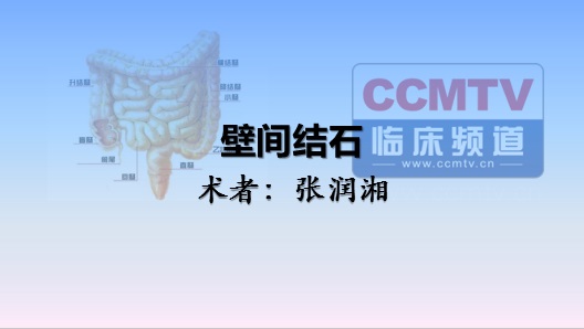张润湘：壁间结石