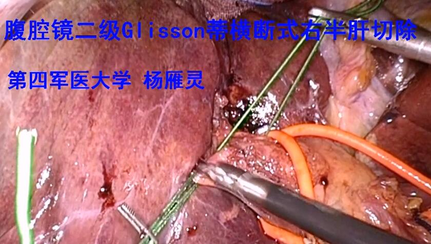 杨雁灵：腹腔镜二级Glisson蒂横断式右半肝切除