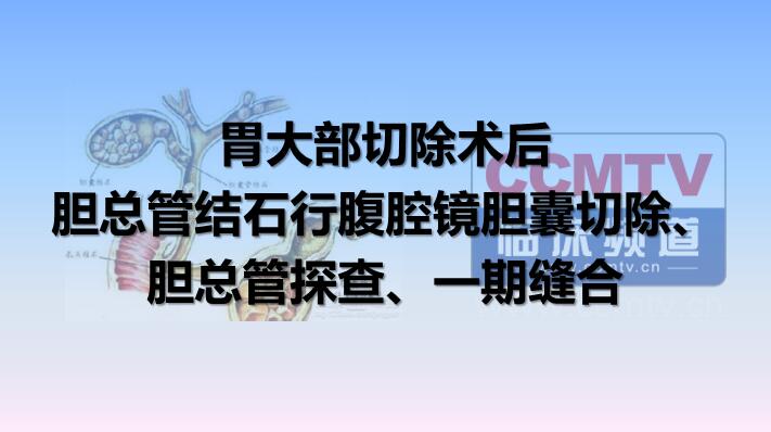 胆总管结石行腹腔镜胆囊切除、胆总管探查、一期缝合