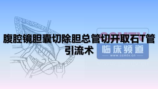 腹腔镜胆囊切除胆总管切开取石T管引流术