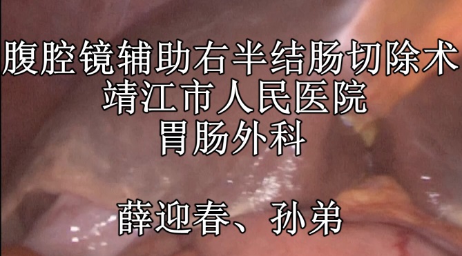 薛迎春：腹腔镜辅助右半结肠切除术