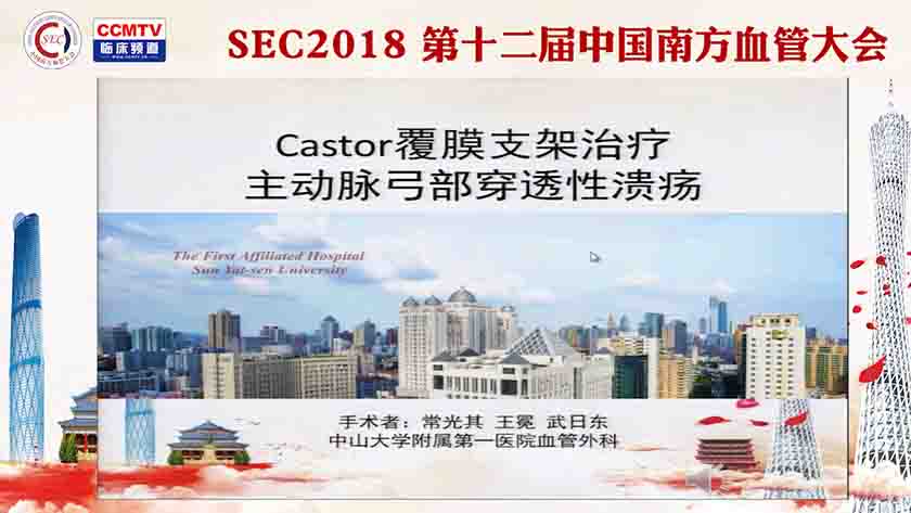 Castor覆膜支架治疗主动性弓部穿透性溃疡