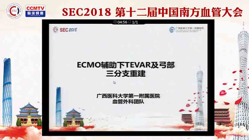 ECMO辅助下TEVAR及弓部三分支重建