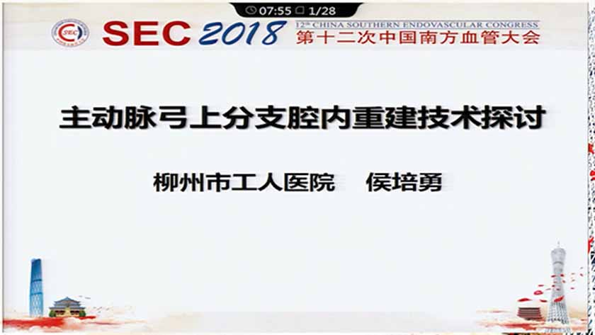 主动脉弓上分支腔内重建技术探讨