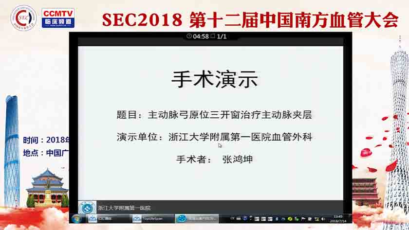 主动脉弓原位三开窗治疗主动脉夹层