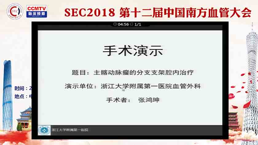 主骼动脉瘤的分支支架腔内治疗