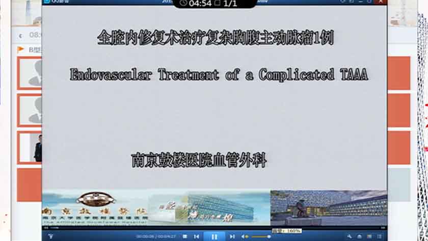 全腔内修复术治疗复杂胸腹主动脉瘤1例