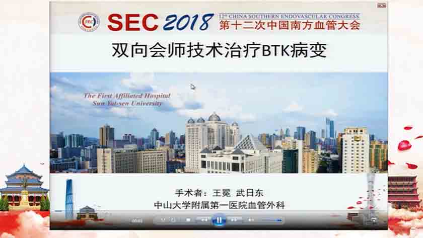 双向会师技术治疗BTK病变