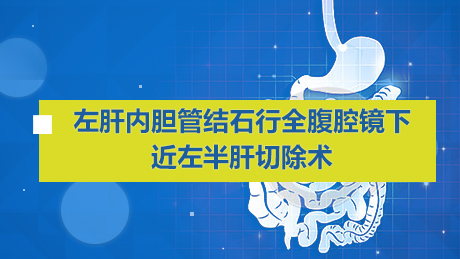 左肝内胆管结石行全腹腔镜下近左半肝切除术