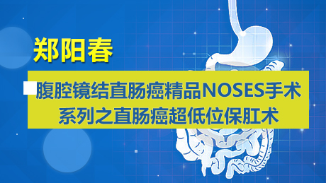 郑阳春：腹腔镜结直肠癌精品NOSES手术系列之直肠癌超低位保肛术