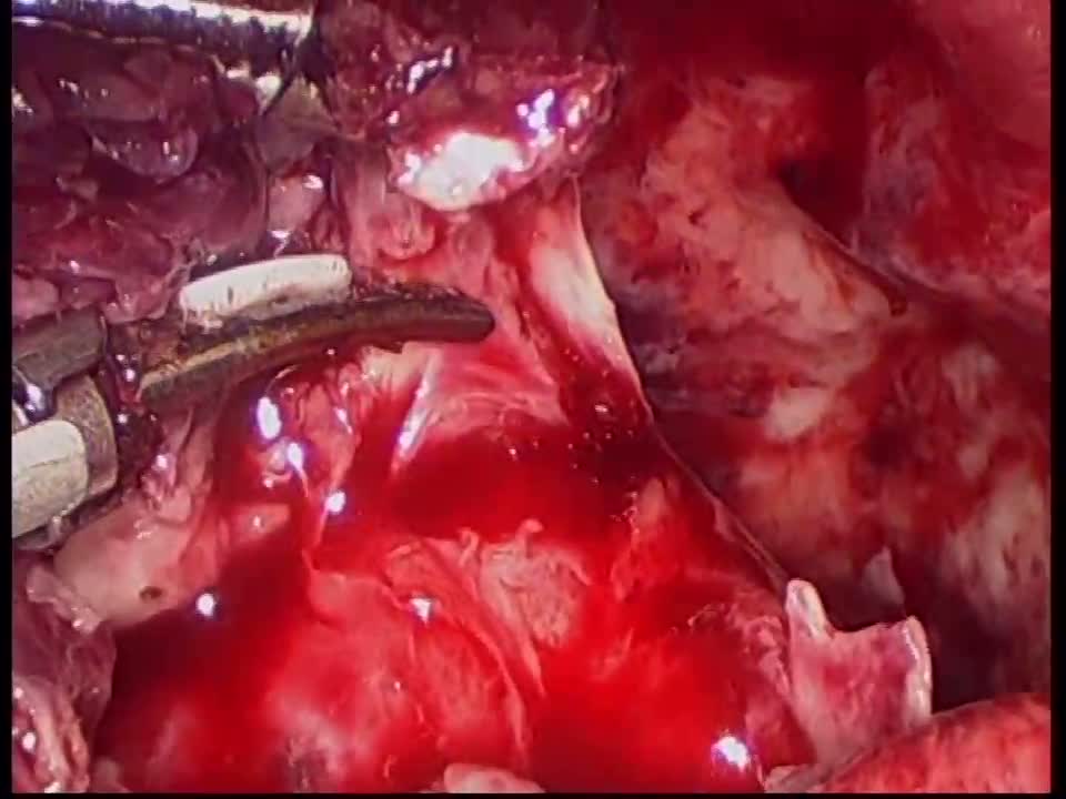 腹腔镜下阑尾周围脓肿敞开引流+阑尾切除术（8岁巨大脓肿）2