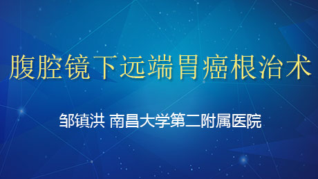 邹镇洪：腹腔镜下远端胃癌根治术