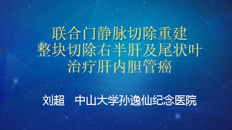 刘超：联合门静脉切除重建整块切除右半肝及尾状叶治疗肝内胆管癌