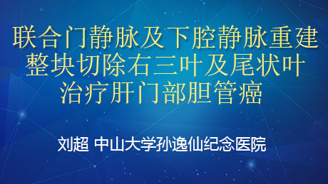 刘超：联合门静脉及下腔静脉重建整块切除右三叶及尾状叶治疗肝门部胆管癌