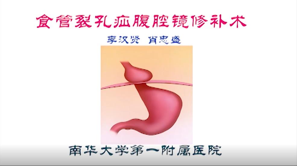 李汉贤，肖忠盛：食管裂孔疝腹腔镜修补术